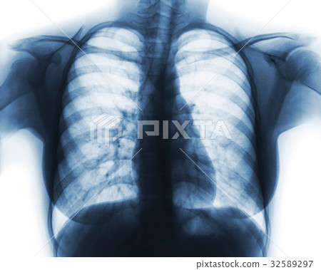 Film chest x-ray of normal woman chest 32589297