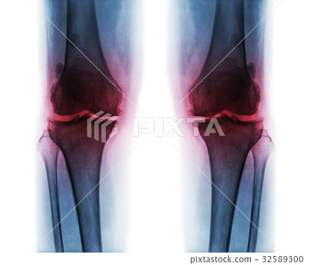 Osteoarthritis both knee . Osteoarthritis both knee . 32589300