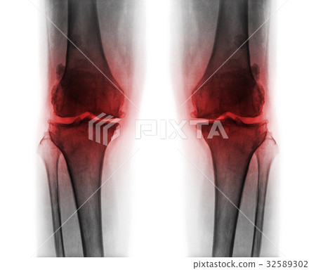 Osteoarthritis both knee . Osteoarthritis both knee . 32589302