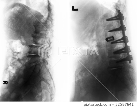 Spondylosis . Before and After surgery . 32597641