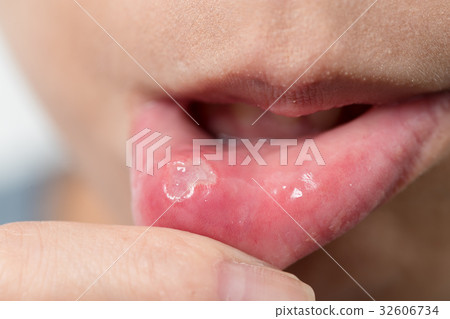 Woman suffer from aphtha 32606734