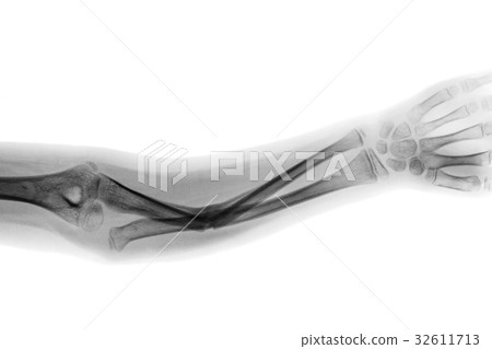 x-ray forearm AP show fracture shaft of ulnar bone 32611713