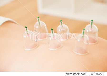 close up of cupping treatment on back 32646276