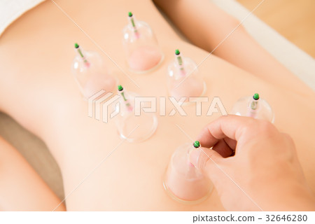 acupuncture therapist removing a cupping 32646280