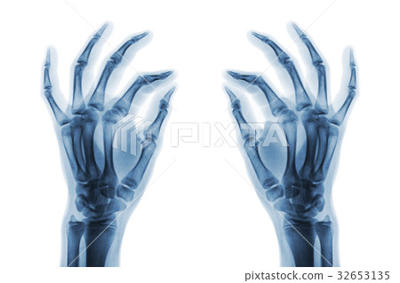 X-ray normal human hands on white background . 32653135