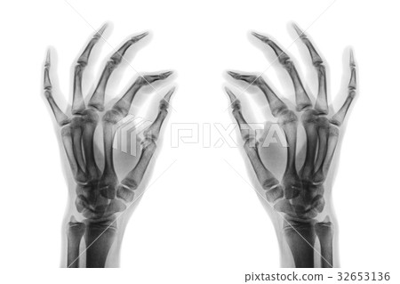 X-ray normal human hands on white background . X-ray normal human hands on white background . 32653136