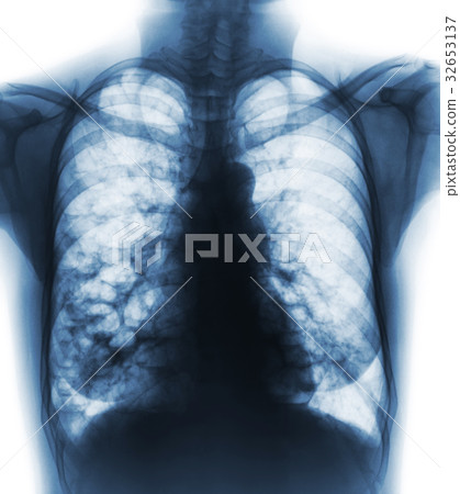 Bronchiectasis .   32653137