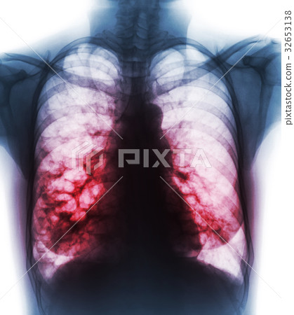 Bronchiectasis . Bronchiectasis . 32653138