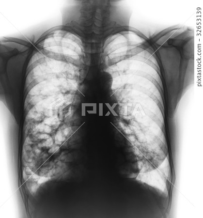 Bronchiectasis . Bronchiectasis . 32653139