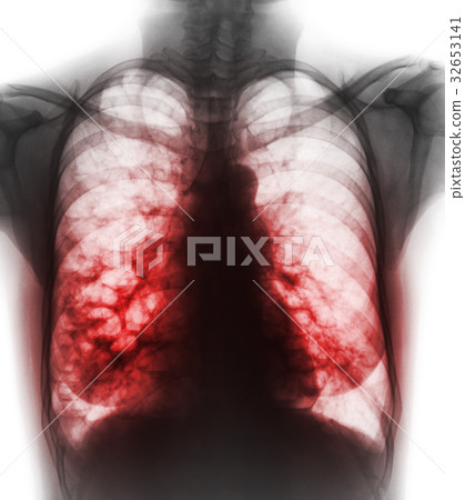 Bronchiectasis . Bronchiectasis . 32653141