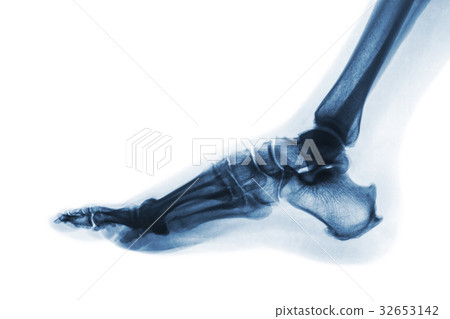 X-ray normal human foot . Lateral view . X-ray normal human foot . Lateral view . 32653142