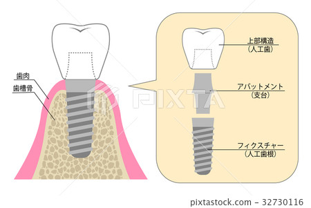 Explanation of Implant 32730116