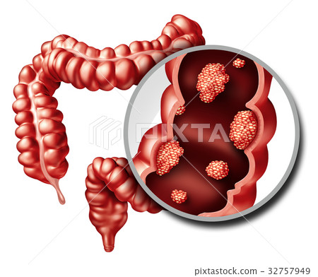 Colon Cancer Concept 32757949