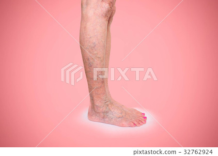 Varicose veins on a female legs 32762924