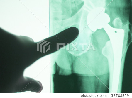 Hip joint replacement impant Hip joint replacement impant 32788839