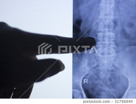 Back spine vertabrae xray scan Back spine vertabrae xray scan 32788840