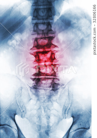 Spondylosis . 32806166