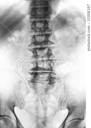 Spondylosis  32806167