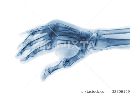 Fracture at 3rd and 4th metacarpal bone . Fracture at 3rd and 4th metacarpal bone . 32806169