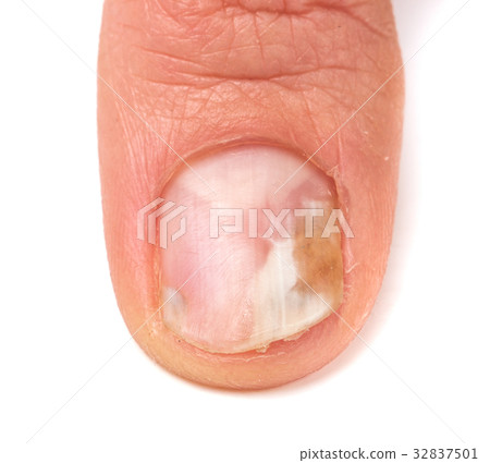 one finger of the hand with a fungus on the nails 32837501