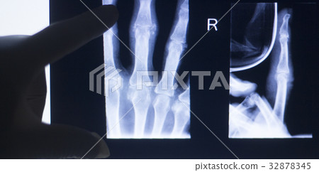Hand fingers xray test scan Hand fingers xray test scan 32878345