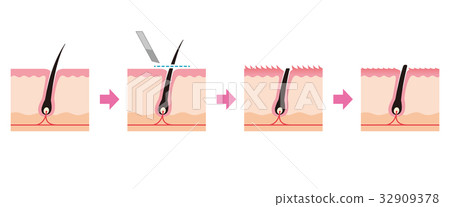 Cross section view of waste hair treatment razor hair 32909378