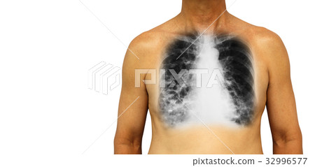 Bronchiectasis . Bronchiectasis . 32996577