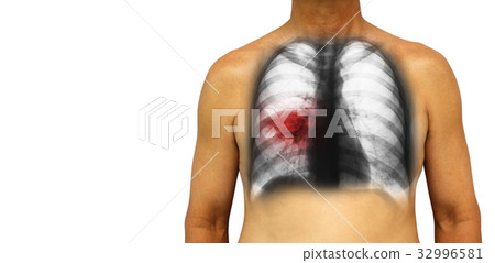 Pulmonary tuberculosis . Pulmonary tuberculosis . 32996581