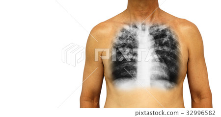 Pulmonary tuberculosis . Pulmonary tuberculosis . 32996582