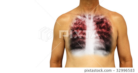 Pulmonary tuberculosis . Pulmonary tuberculosis . 32996583