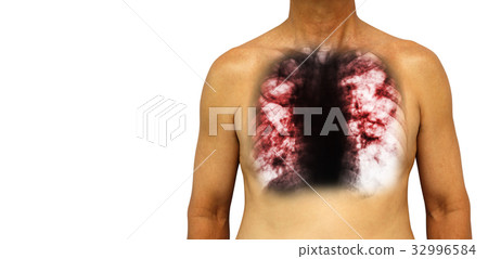 Pulmonary tuberculosis . Pulmonary tuberculosis . 32996584