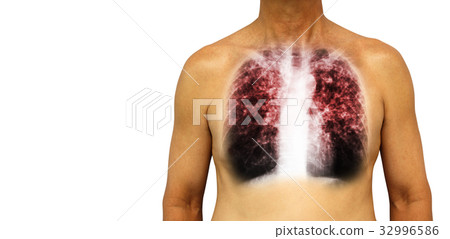 Pulmonary tuberculosis . Pulmonary tuberculosis . 32996586