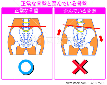 Comparison of pelvic distortion (normal / distorted) (gray-pink, with words) Comparison of pelvic distortion (normal / distorted) (gray-pink, with words) 32997518