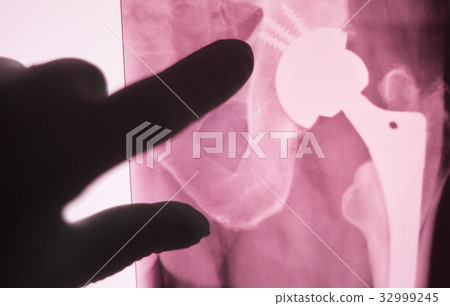 Hip joint replacement impant 32999245