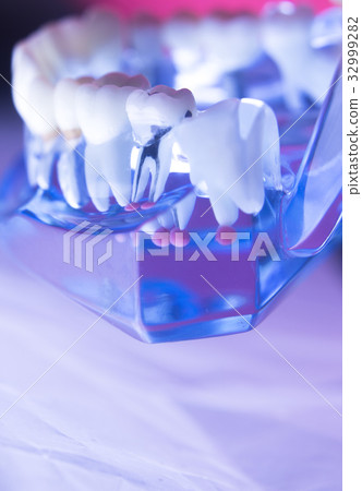Dental tooth root canal Dental tooth root canal 32999282