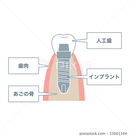 Illustration material of implant Illustration material of implant 33001394