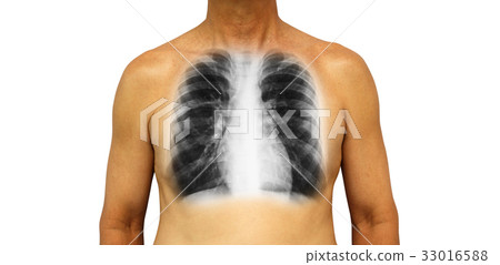 Human chest with x-ray of normal lung . Human chest with x-ray of normal lung . 33016588