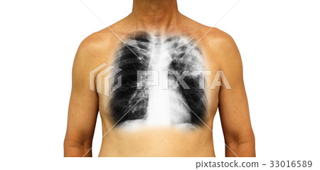 Pulmonary tuberculosis . Pulmonary tuberculosis . 33016589