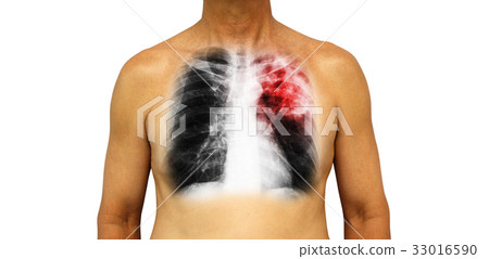 Pulmonary tuberculosis .  33016590
