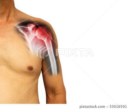 fracture at neck of humerus ( Arm bone ) fracture at neck of humerus ( Arm bone ) 33016591