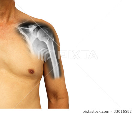 fracture at neck of humerus ( Arm bone ) fracture at neck of humerus ( Arm bone ) 33016592