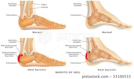 Heel Bursitis 33100533