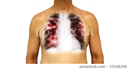 Pulmonary tuberculosis .  33106200