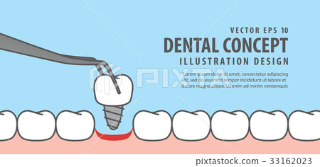 Banner Implant tooth install illustration vector 33162023
