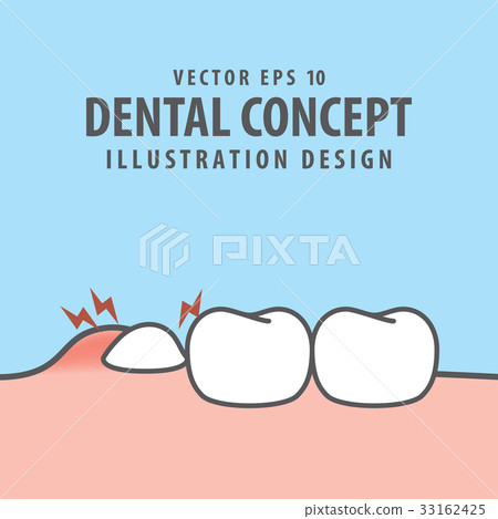 Impacted tooth inside under inflammation gum 33162425