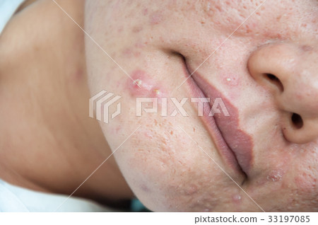 Chronic acne skin on woman surface Chronic acne skin on woman surface 33197085