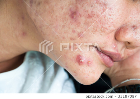 Chronic acne skin on woman surface Chronic acne skin on woman surface 33197087