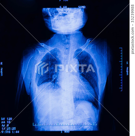 View of a child x-ray film, taken to examine View of a child x-ray film, taken to examine 33239988