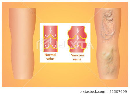 Varicose veins on a female senior leg Varicose veins on a female senior leg 33307699