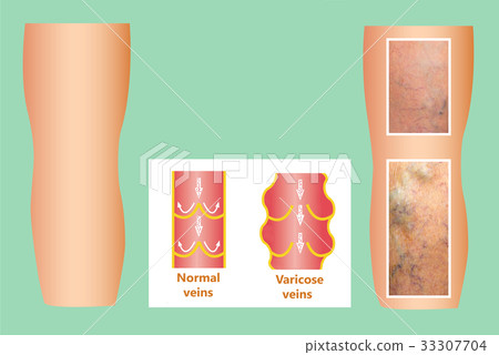 Varicose veins on a female senior leg Varicose veins on a female senior leg 33307704